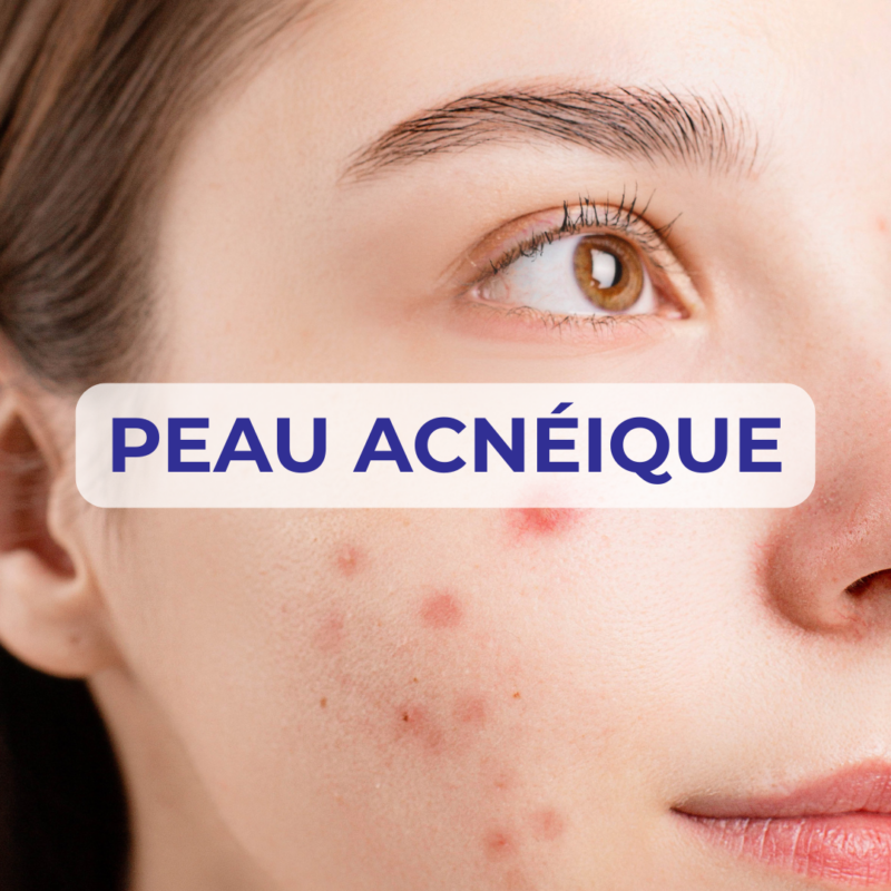 Peau Acnéique